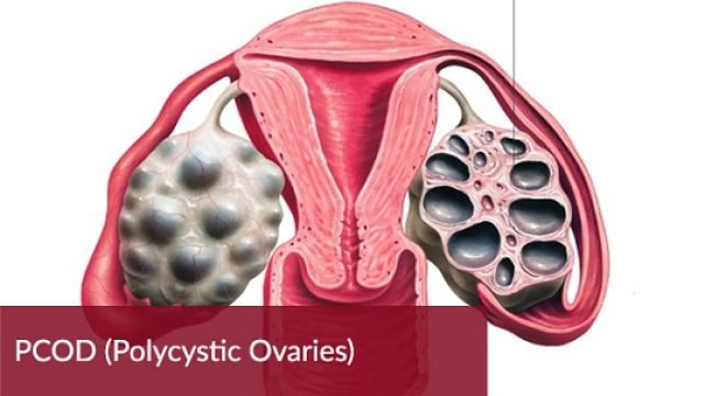 PCOD-Polycystic-Ovaries - 360